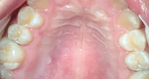 Clinical Uses for Silver Diamine Fluoride - Oral Health Group