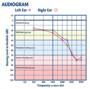 Typical hearing loss following long standing excessive noise exposure (Nationalhearingtest.org).