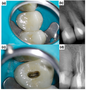 Tooth #1.4 diagnosed with a necrotic pulp and symptomatic apical periodontitis.