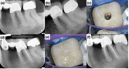 Symptomatic mandibular first molar with a radiographic periapical radiolucency treated in two visits.