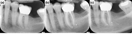 Symptomatic mandibular first molar with a radiographic periapical radiolucency (b) Post-operative radiograph showing conservative canal instrumentation and placement of amalgam core.