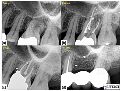 Pre-operative radiograph of tooth #2.6. (b) Post-operative radiograph with temporary restoration. (c) 1-year follow-up. (d) Tooth #2.6 has been extracted at the 3-year follow-up.