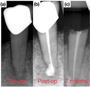 Tooth #4.5 diagnosed with a necrotic pulp and symptomatic apical periodontitis. (b) Post-operative radiograph (no post was cemented). (c) Crown “snap off” failure occurred 2 months following treatment.