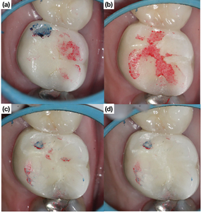 Occlusal management of an upper molar. (a-b) Blue marking used for centric occlusal contacts and red marking used for eccentric (interferences) occlusal contacts.