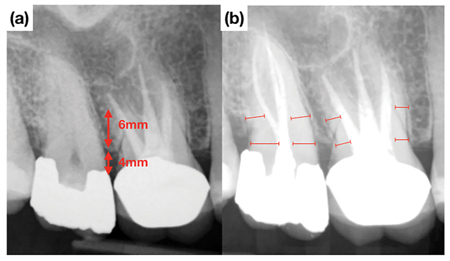 Pre-operative radiograph of tooth #1.7 diagnosed with symptomatic irreversible pulpitis.