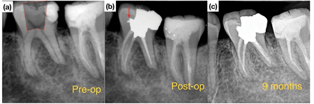 Tooth #3.6 diagnosed with a necrotic pulp and symptomatic apical periodontitis. Simulated traditional straight-line access