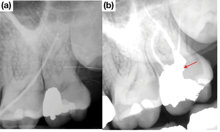 Tooth #2.7 diagnosed with a necrotic pulp and chronic apical abscess.