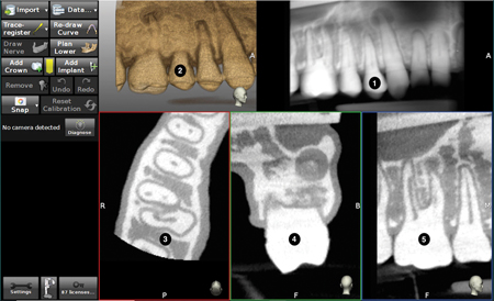 The screen is divided into; 1. Panoramic view, 2. 3D reconstruction, 3. Axial view 4. Buccal-lingual and 5. Mesio-distal section views.