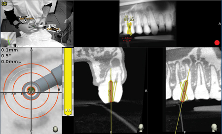 Maxillary molar – The planned canal location is on target [yellow 0.0mm].