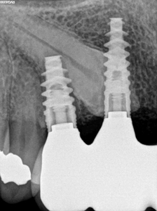 Unconventional Implant Placement Through An Impacted Canine