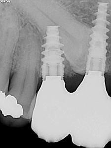 Unconventional Implant Placement Through An Impacted Canine