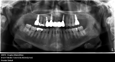 Unconventional Implant Placement Through An Impacted Canine