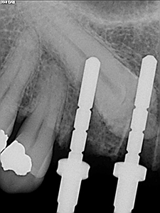 Unconventional Implant Placement Through An Impacted Canine