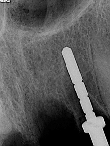 Unconventional Implant Placement Through An Impacted Canine