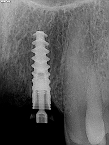 Unconventional Implant Placement Through An Impacted Canine