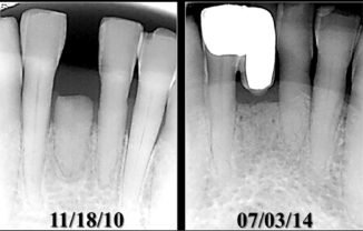 Zirconia – Separating Fact From Fiction - Oral Health Group