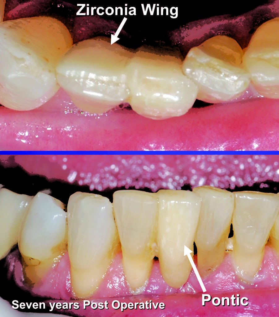 Zirconia Separating Fact From Fiction Oral Health Group