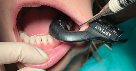 Intraoral splint contralateral to the surgical site.