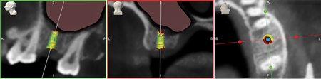 Red coloring on a planned 8 mm implant indicated likelihood of protrusion into the sinus cavity (pink).