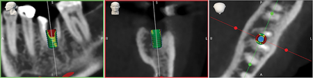 Implant Surgery With Robotic Guidance – Digital Workflows For Patient Care