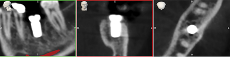 Postop CBCT scan confirming implant placement to plan