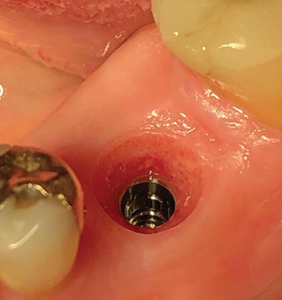 Three months postoperatively, gingival tissues were pink and healthy.