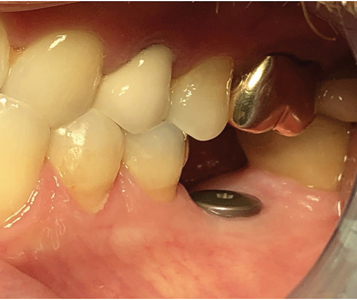 Three months postoperatively, implant appeared clinically and radiographically ready to restore.