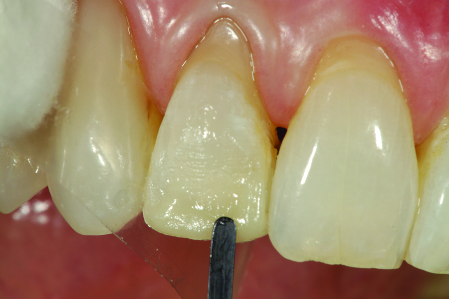 OMNICHROMA BLOCKER (Tokuyama Dental America)