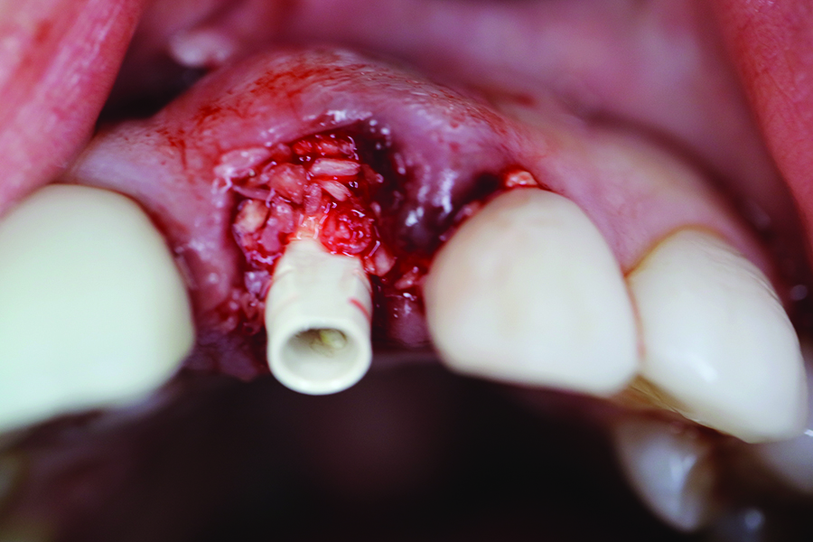 The Peek Temporary Plastic Abutment is fixed on the implant body.