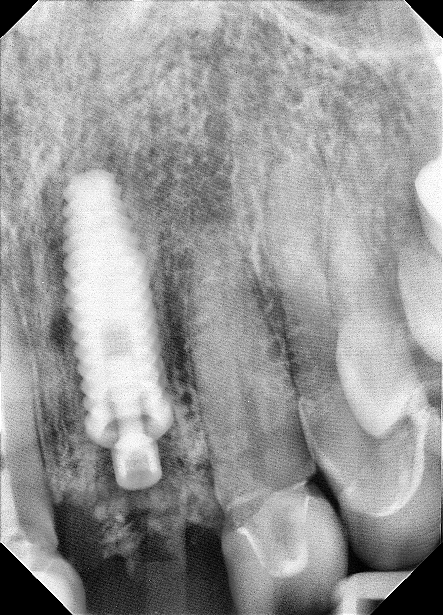 Periapical radiograph of inserted implant with Peek Plastic Temporary Abutment and bone augmentation.