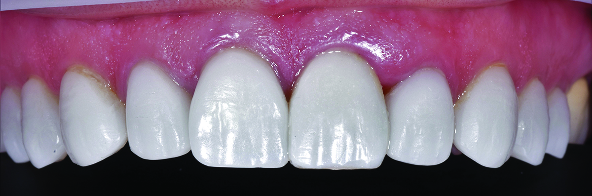 Colour Modifiers To Match An Odd Shade for an esthetic smile.