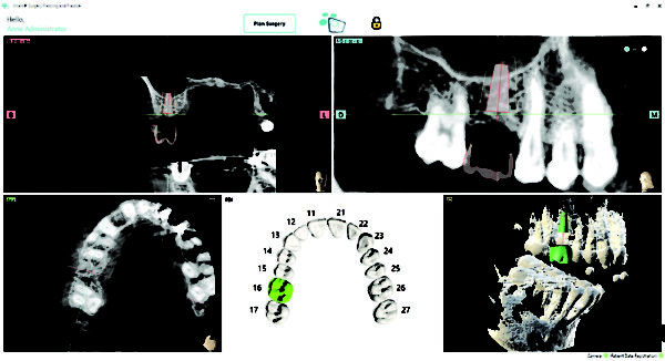 Dynamic Navigation: Implant Placement In Close Proximity To Sinus Floor