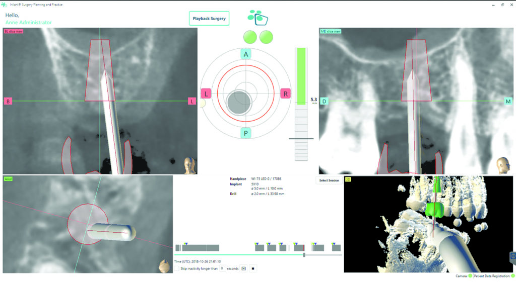 Dynamic Navigation: Implant Placement In Close Proximity To Sinus Floor