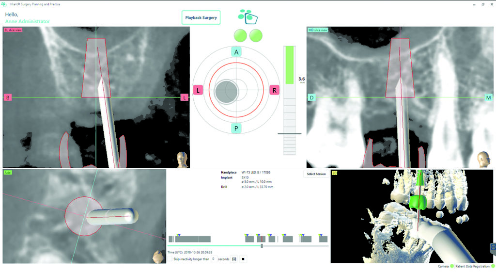 Dynamic Navigation Implant Placement In Close Proximity To Sinus Floor