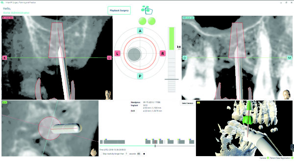 Dynamic Navigation: Implant Placement In Close Proximity To Sinus Floor