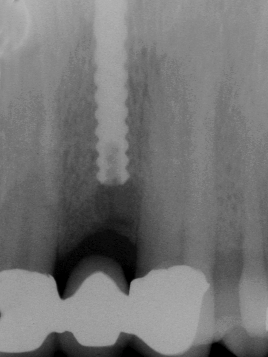 Fractured implant was “buried” and conventionally restored.