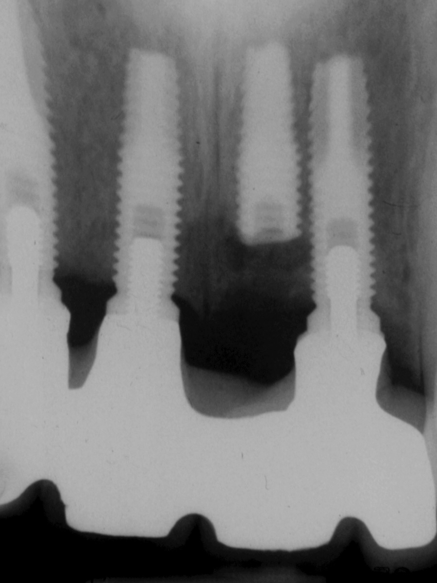 Fractured Grade I implant body at the #2.1 was “buried”.