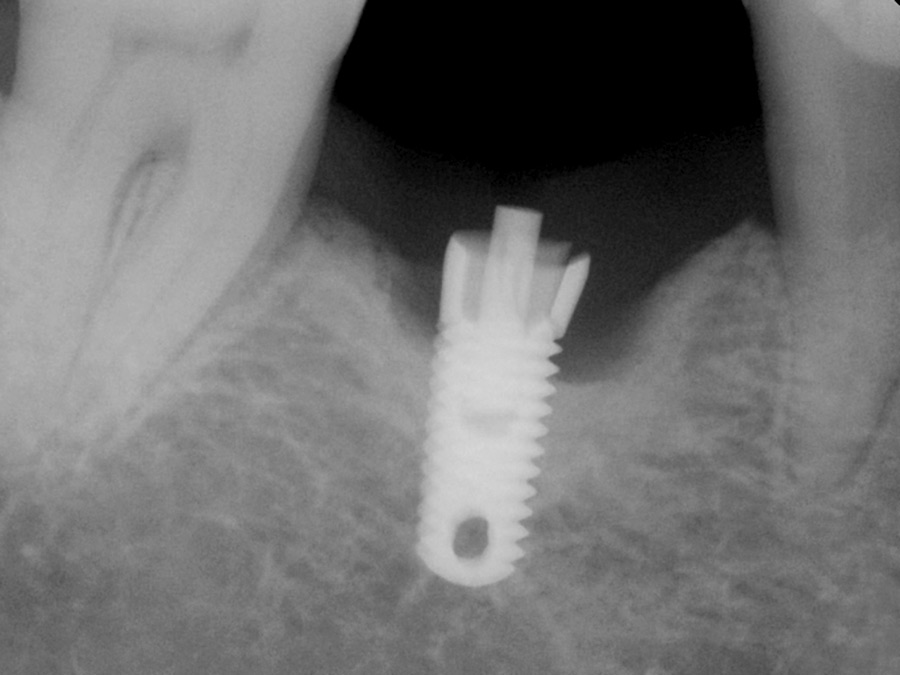 After several years in function the “hex split” occurred.