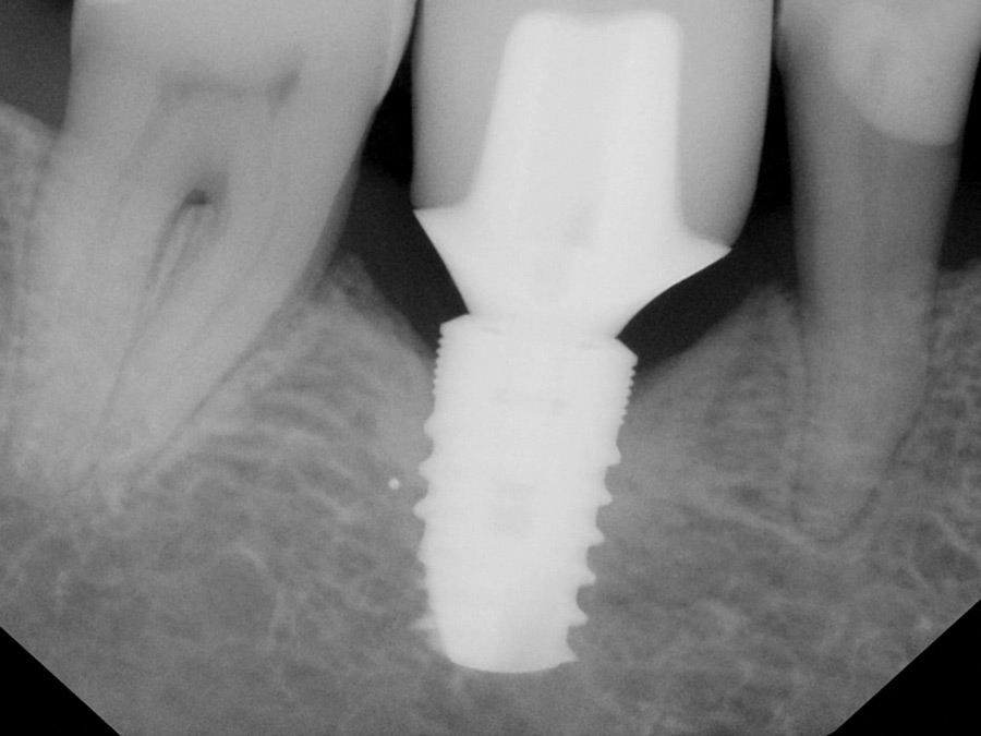 Fractured implant replaced with a wider diameter implant.