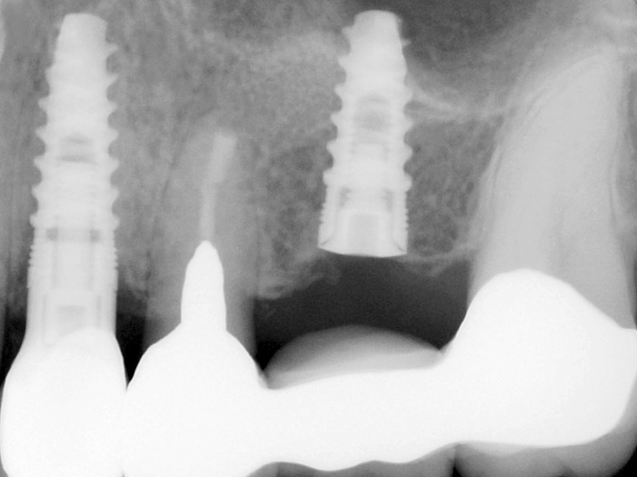 Implant buried at the molar pontic site for potential future use should the conventional bridge fail in the future.