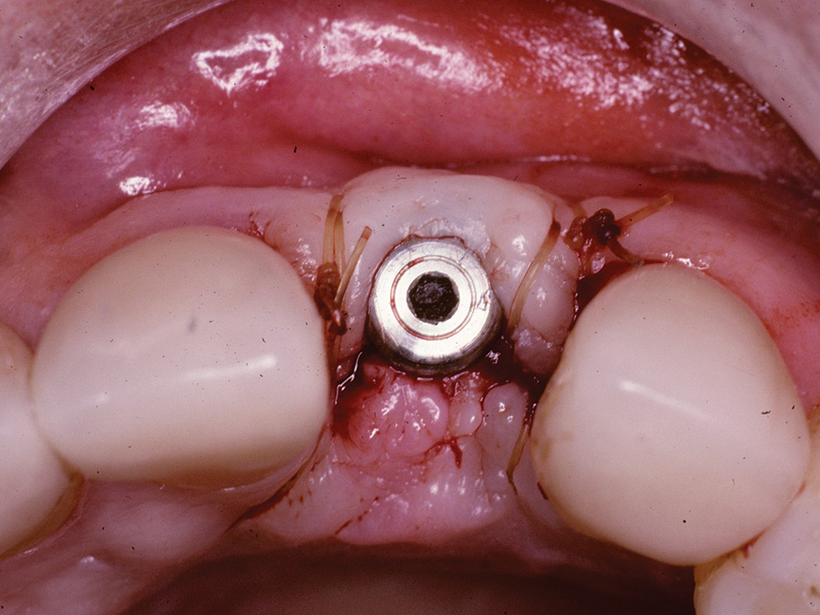 Implant placement is angled too far to the labial.