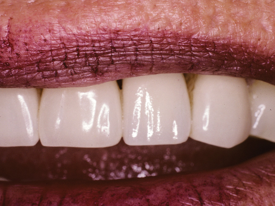 Patient accepted the esthetics due to her low smile line.