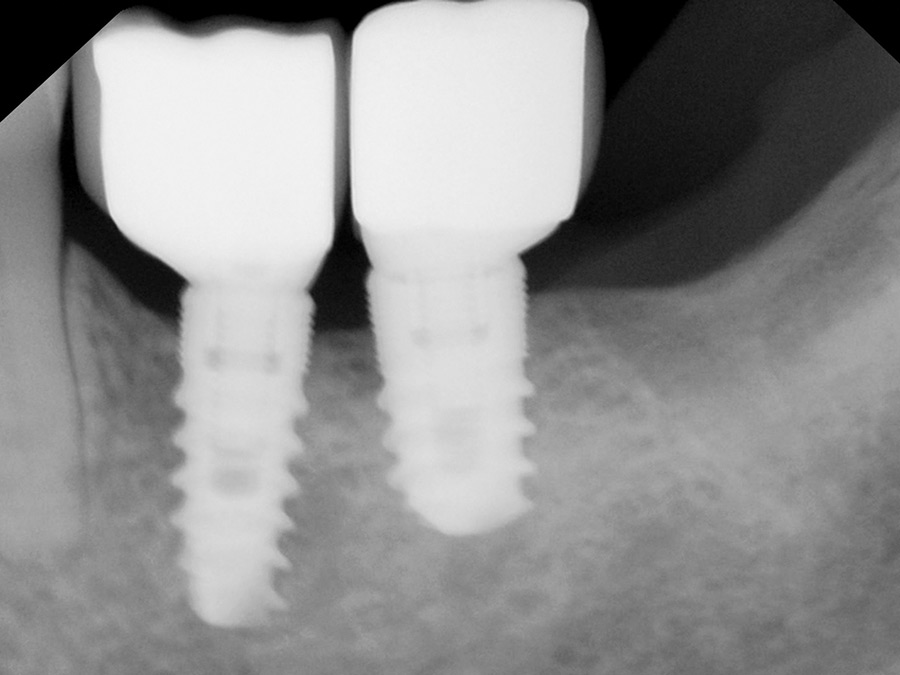 Implant proximity with resultant poor crown contours.