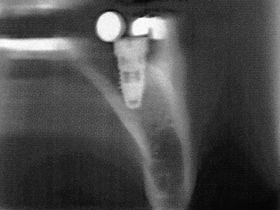 Apical limitation of placement to prevent perforation.