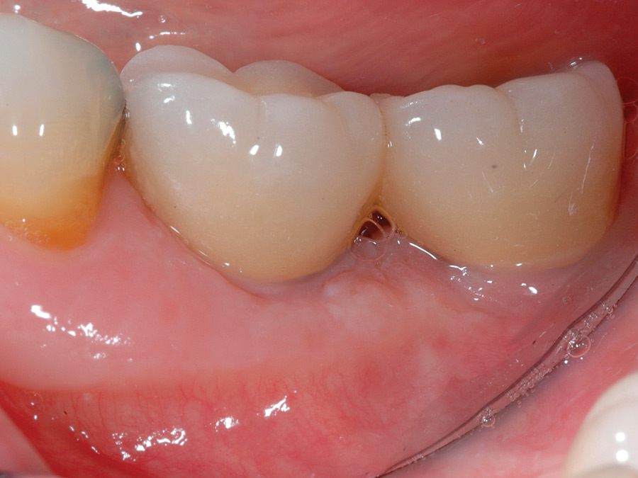 Final crown at 4.6 with apparent normal contours.