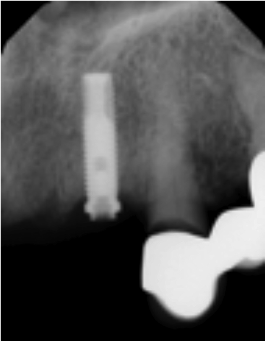 Note the fractured abutment and decay at adjacent tooth.