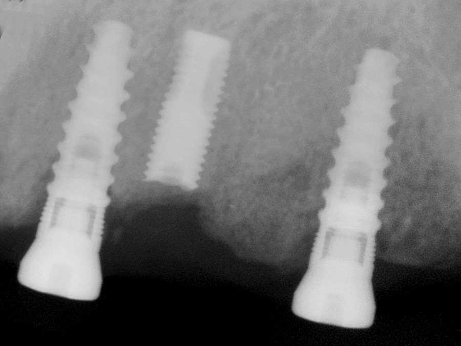 Implant shortened, and two additional implants placed.