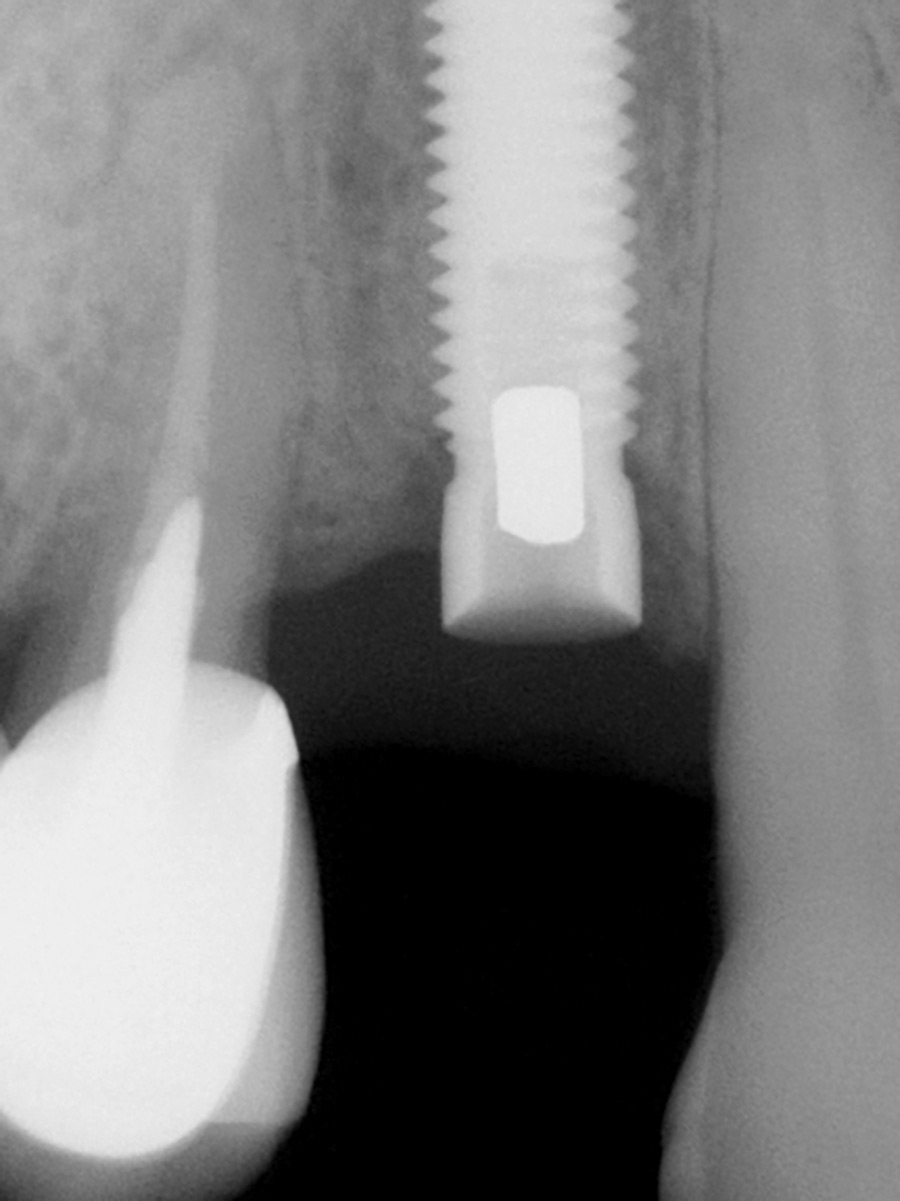 Implant was left in place after the abutment fracture.