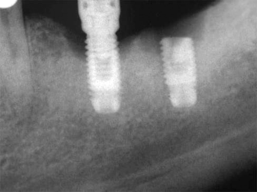 Grade I pure titanium implant body fracture.