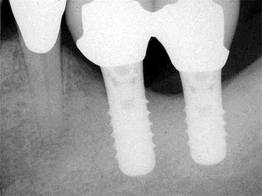 Replacement implants made from Grade IV titanium.